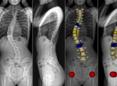 EOS röntgenfelvétel 3-dimenzionális számítógépes modellje gerincferdüléses betegségben