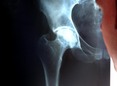 Legtöbb csont és ízületi elváltozást röntgen filmmel diagnoszitzáljuk